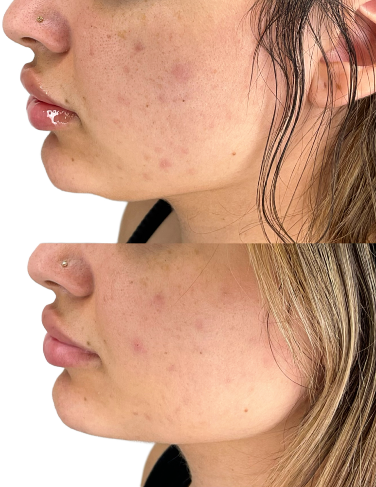 Kybella Before & After