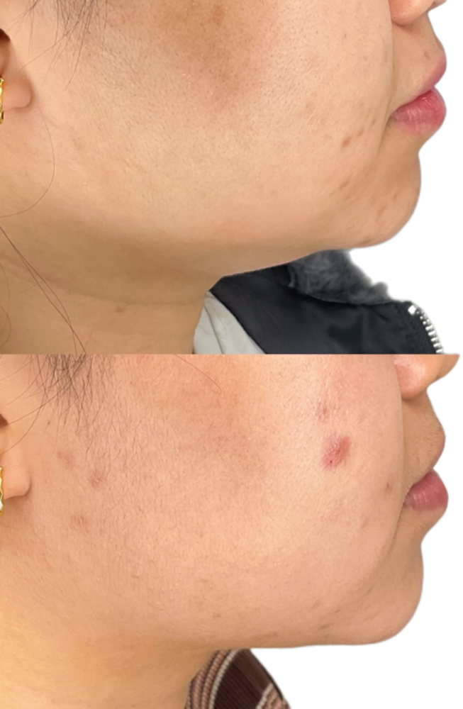 Kybella Before & After