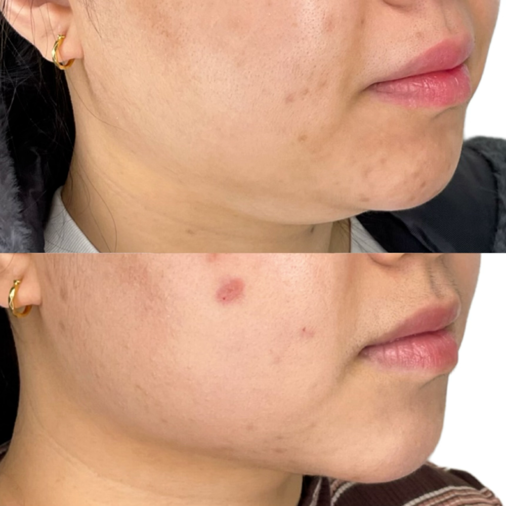 Kybella Before & After