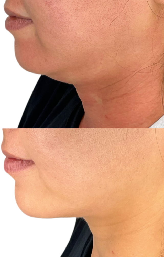 Kybella Before & After