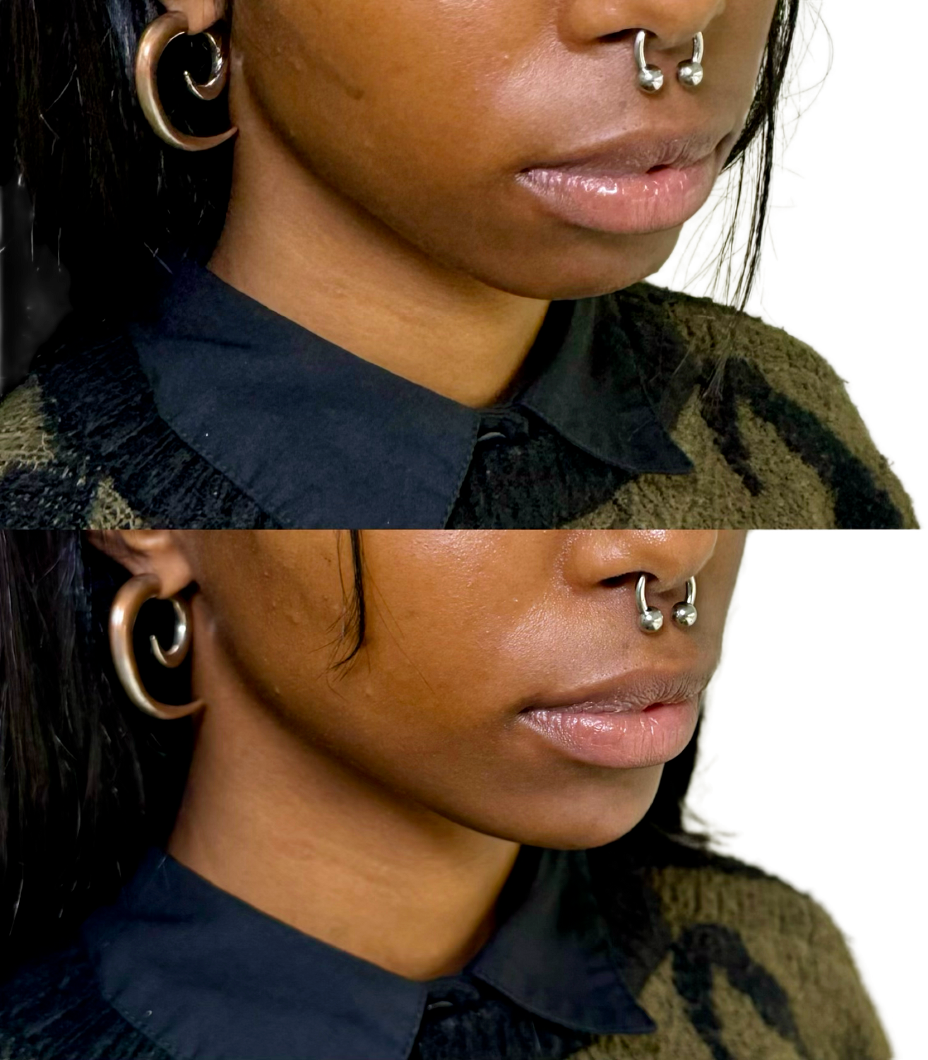 Dermal Fillers Before & After