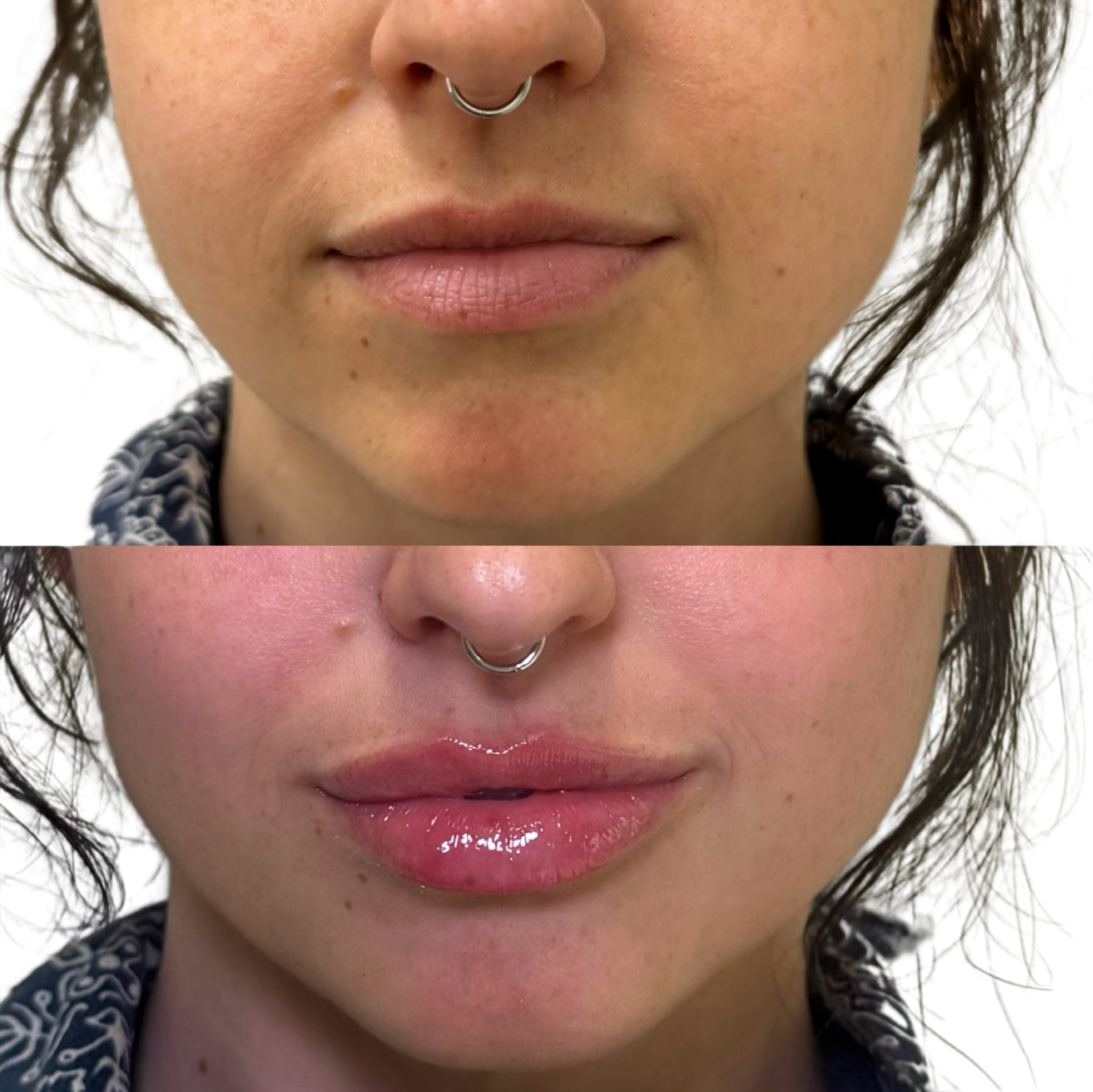 Dermal Fillers Before & After