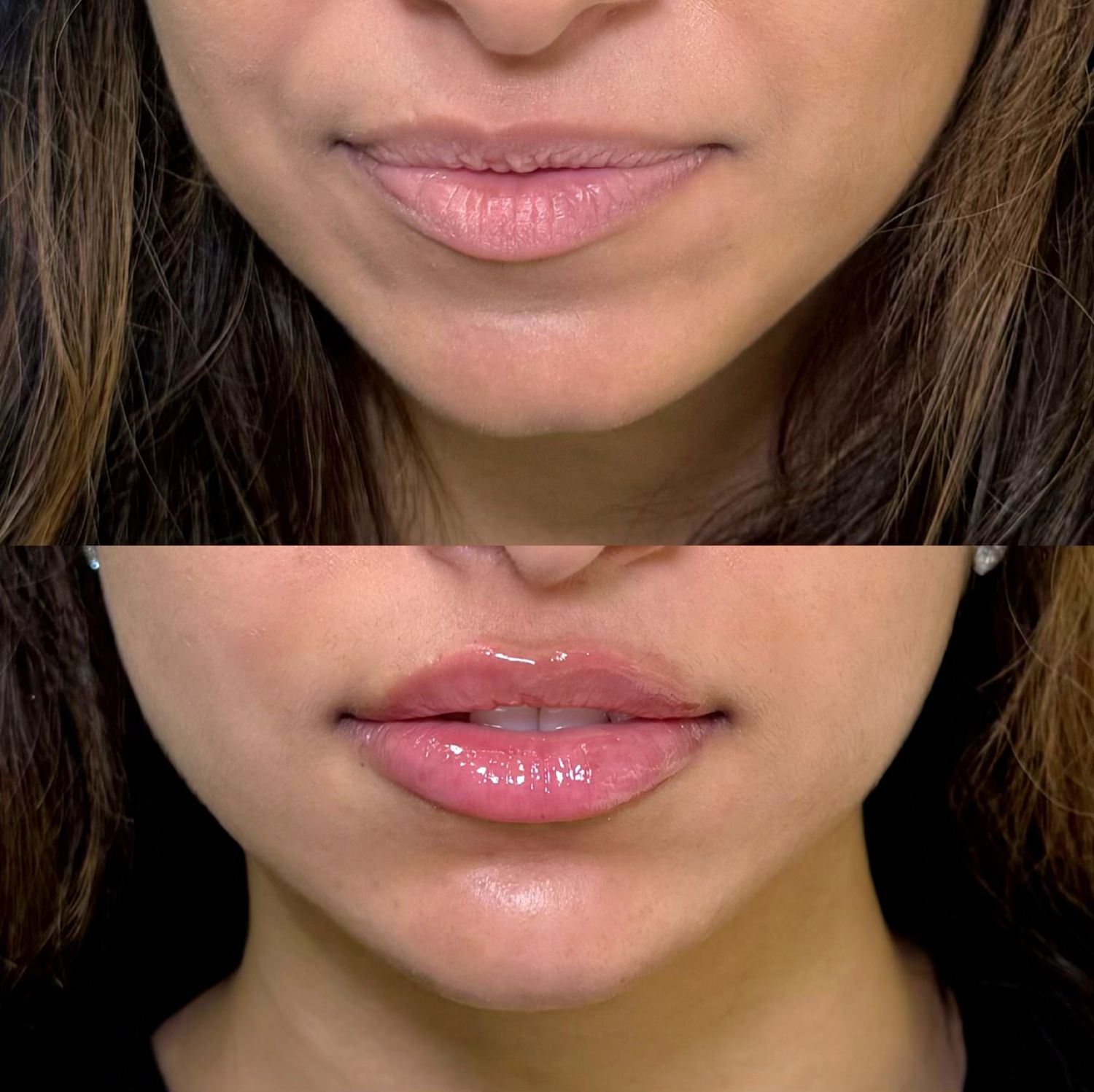 Dermal Fillers Before & After