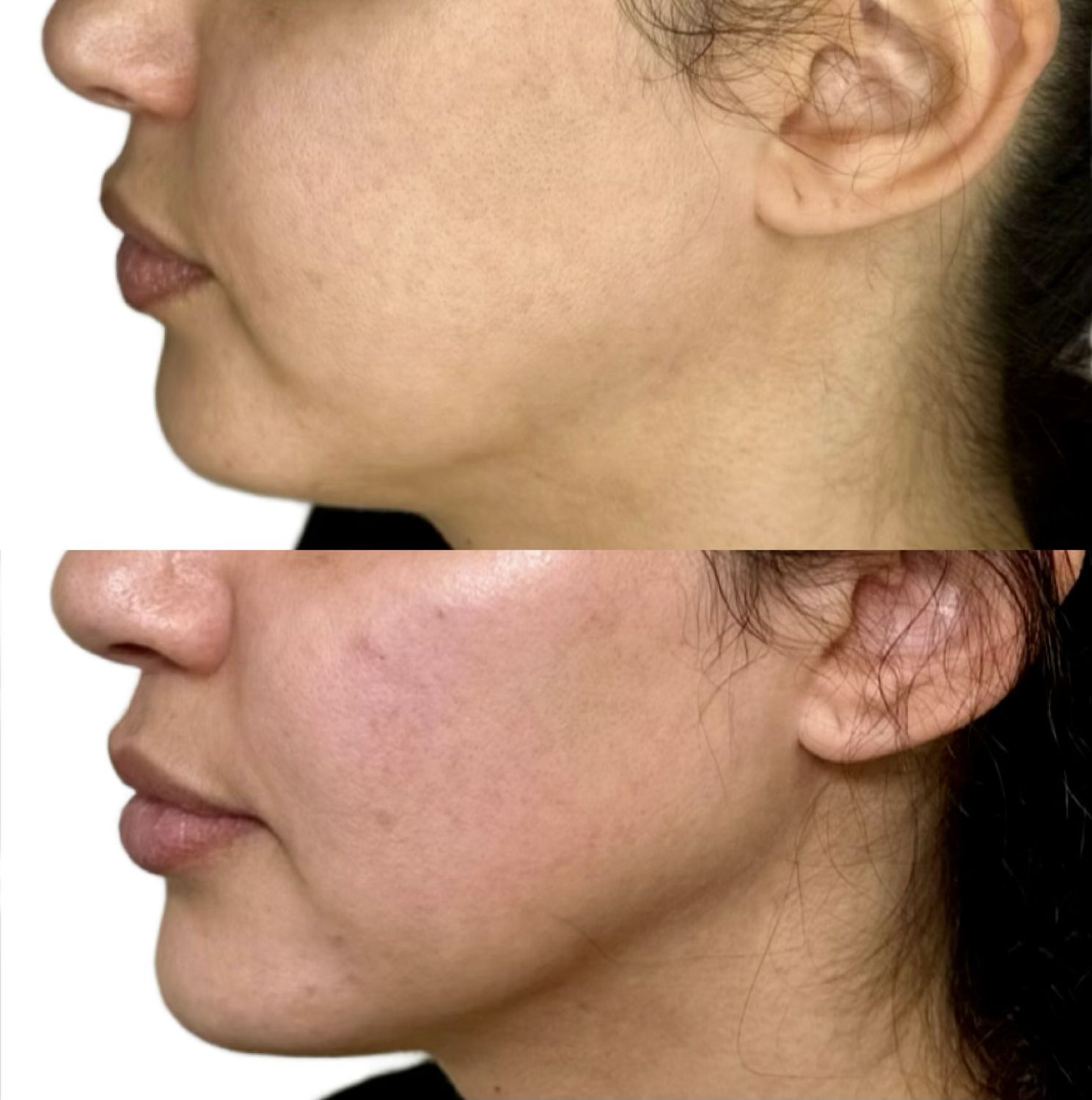 Dermal Fillers Before & After