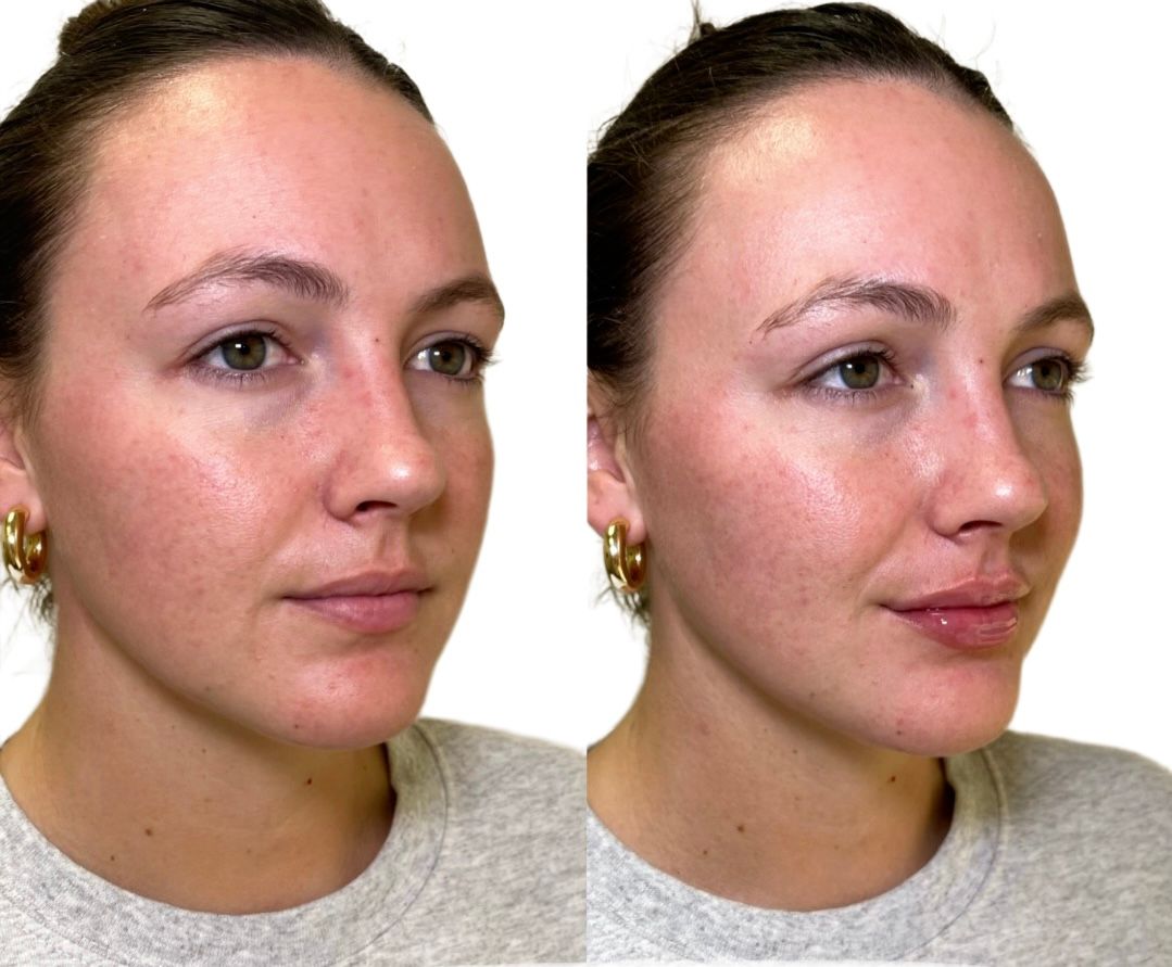 Dermal Fillers Before & After