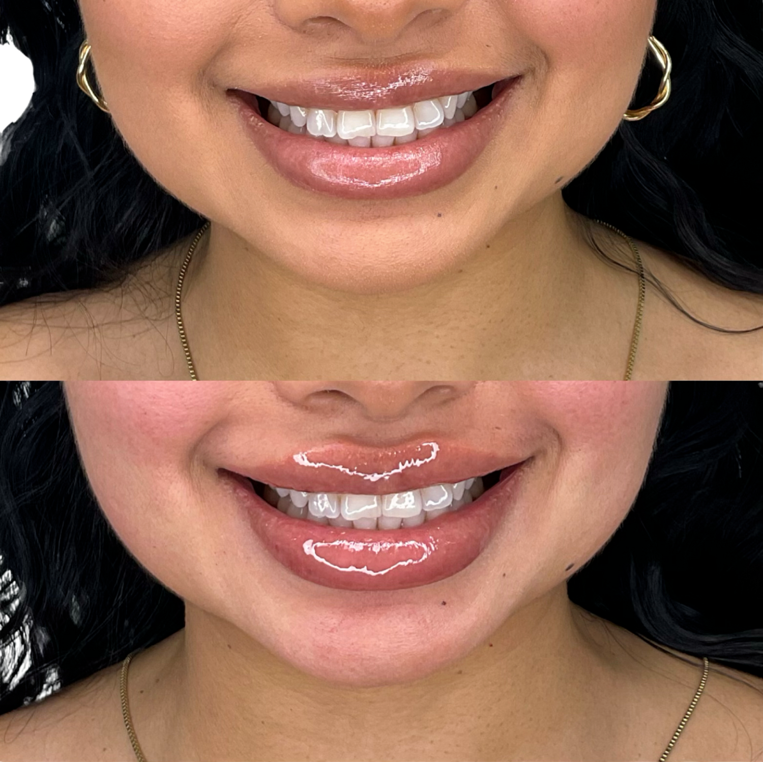 Dermal Fillers Before & After