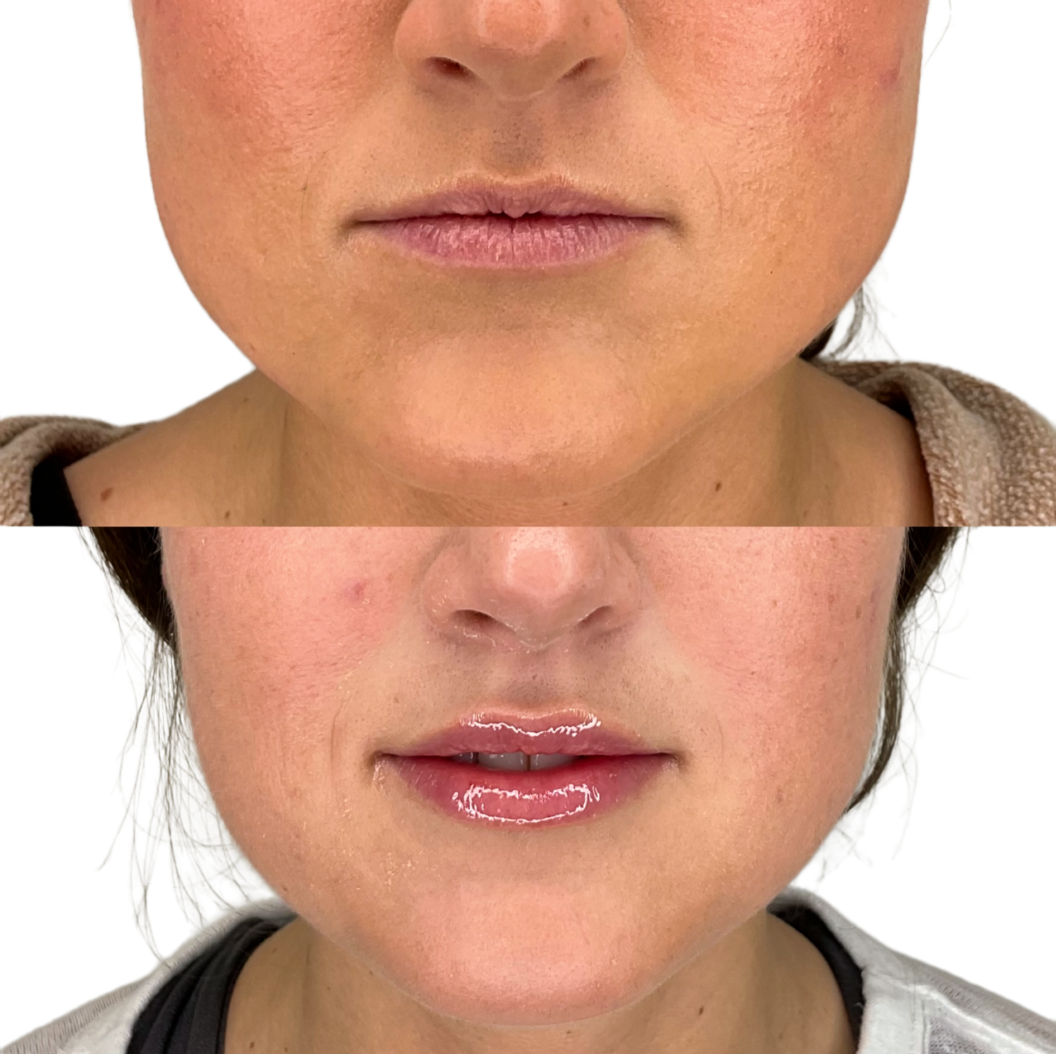 Dermal Fillers Before & After