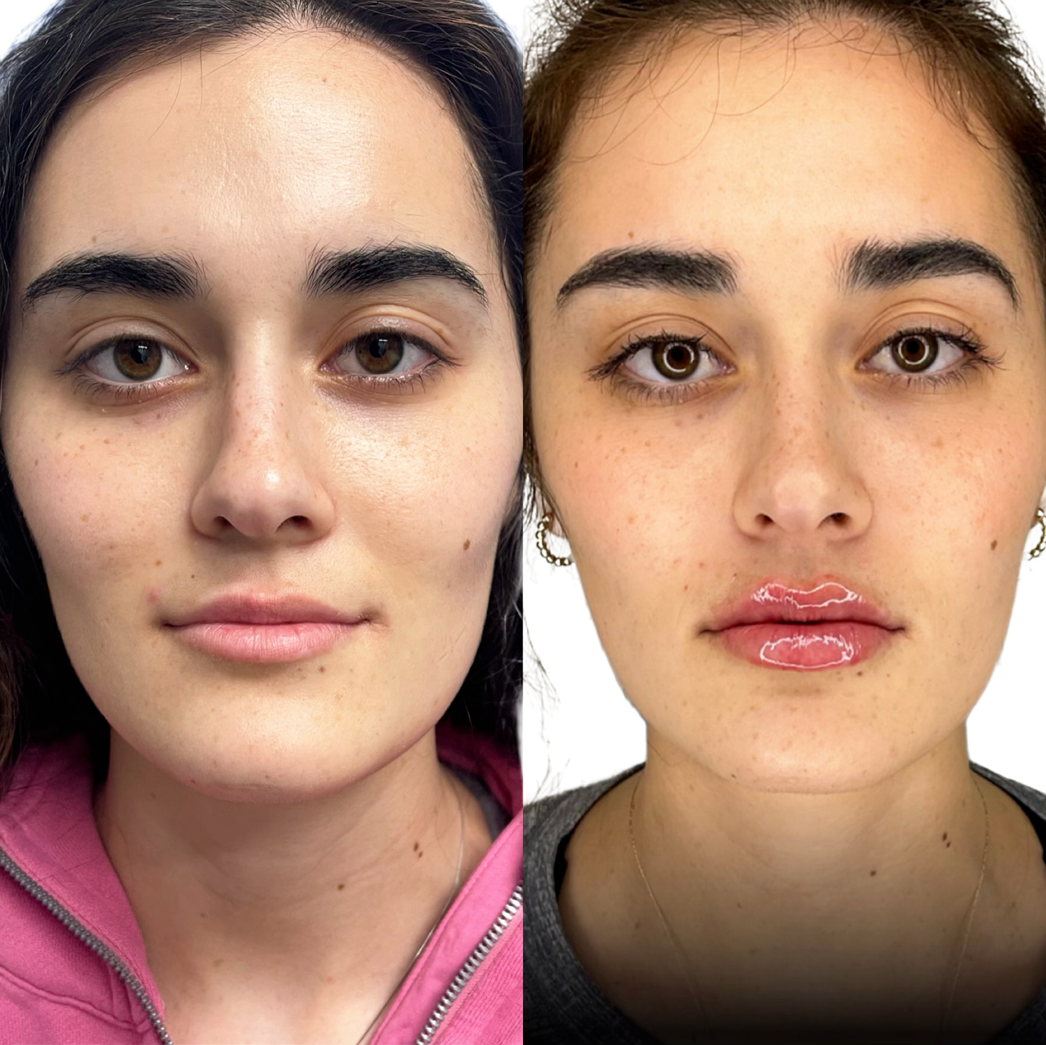 Dermal Fillers Before & After