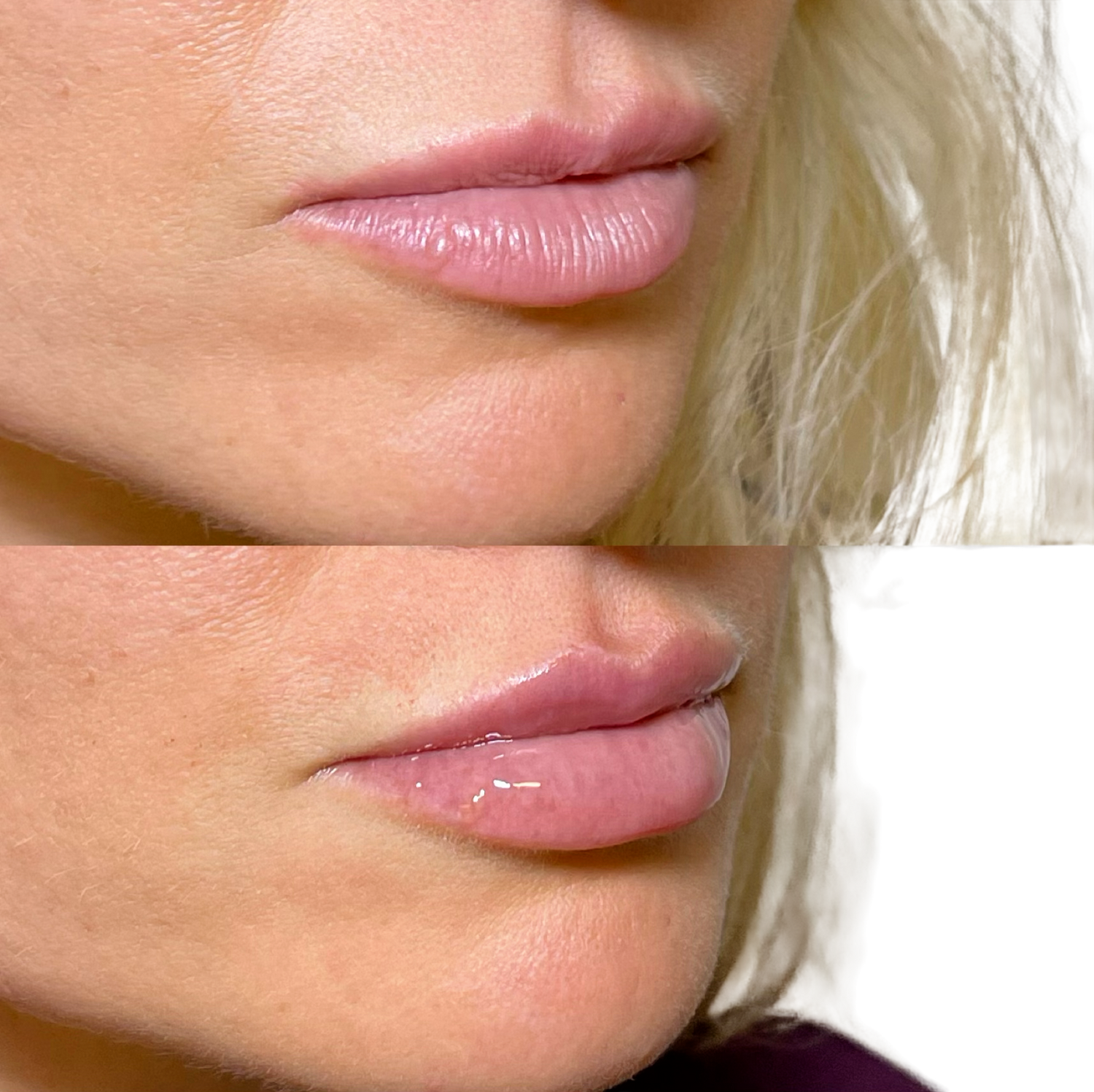 Dermal Fillers Before & After