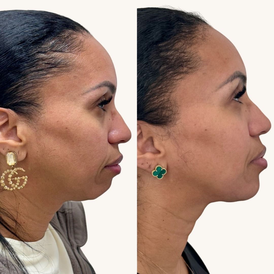 Dermal Fillers Before & After