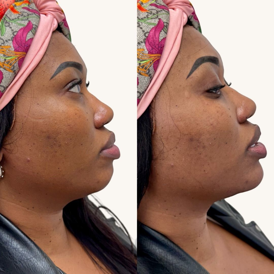 Dermal Fillers Before & After