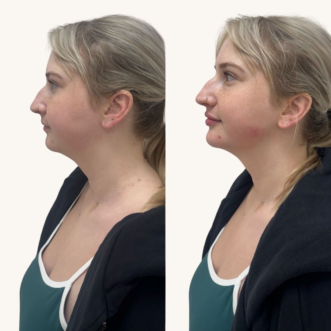 Dermal Fillers Before & After