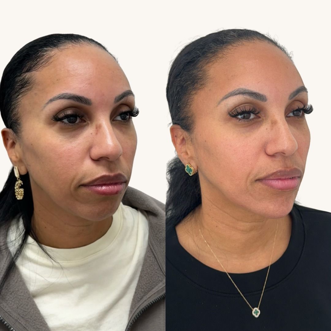 Dermal Fillers Before & After