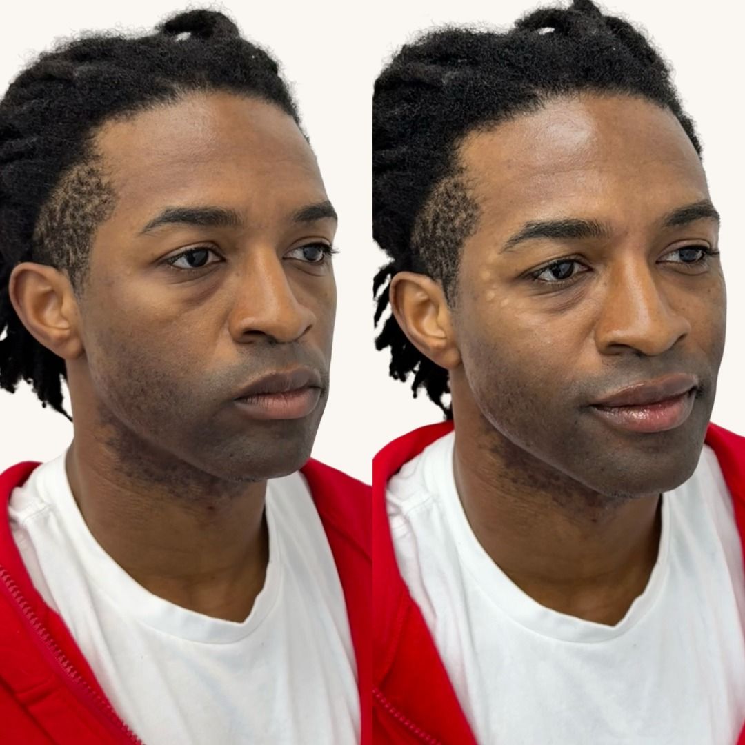 Dermal Fillers Before & After