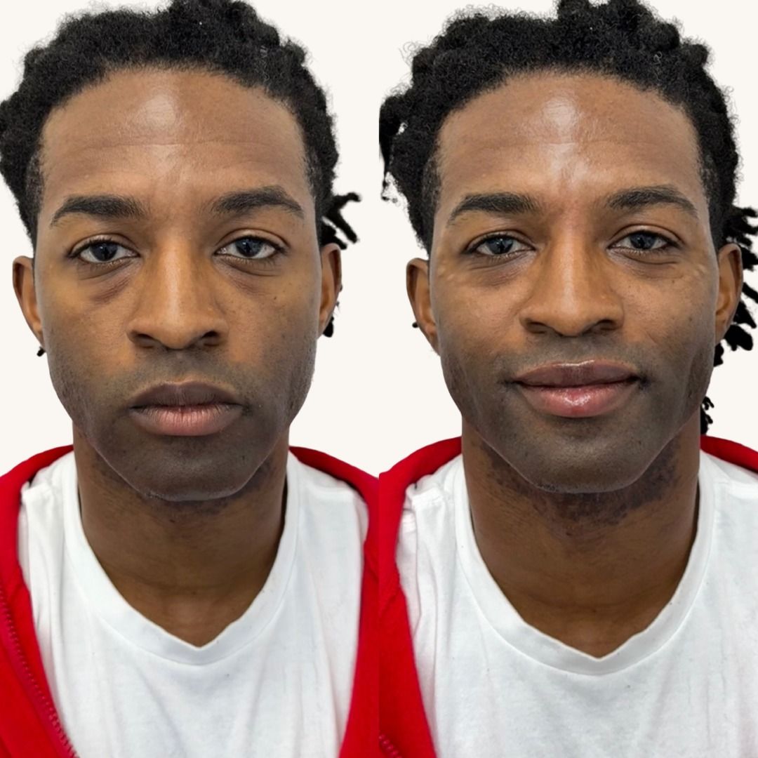 Dermal Fillers Before & After