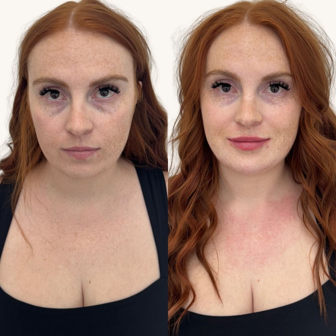Dermal Fillers Before & After