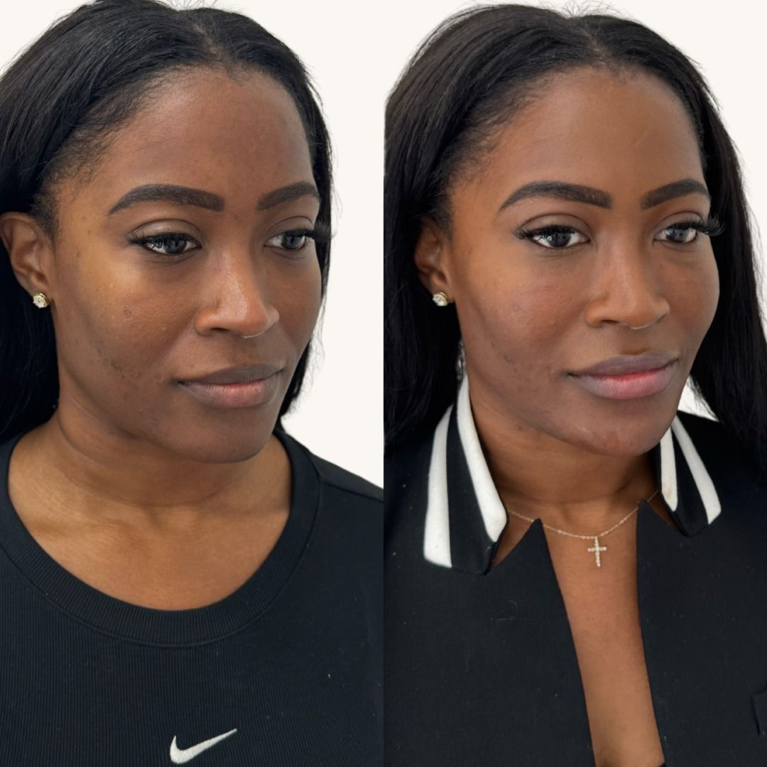 Dermal Fillers Before & After