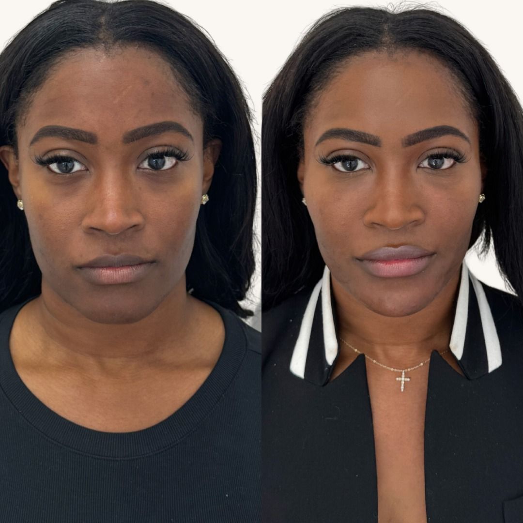 Dermal Fillers Before & After