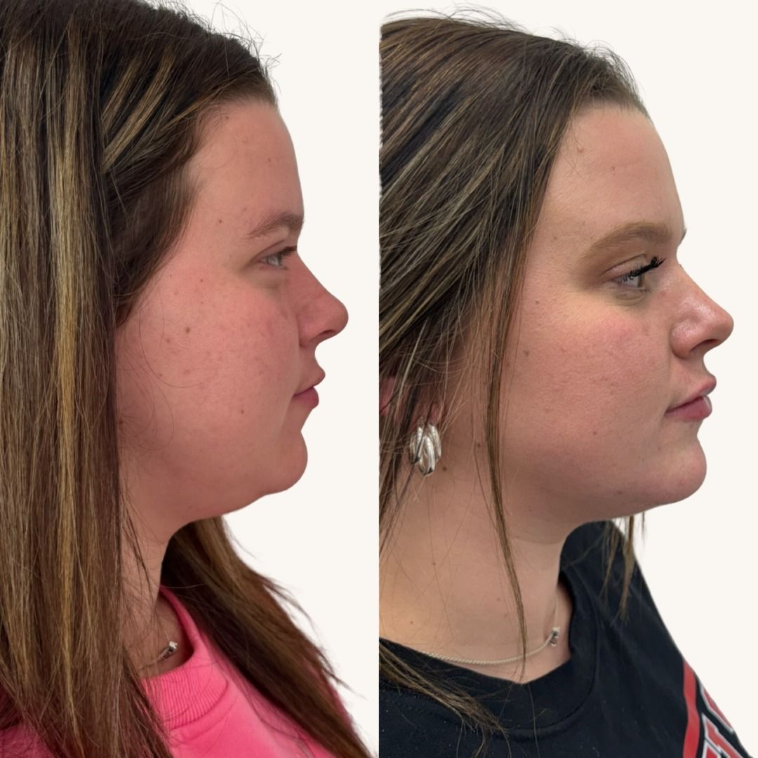 Dermal Fillers Before & After