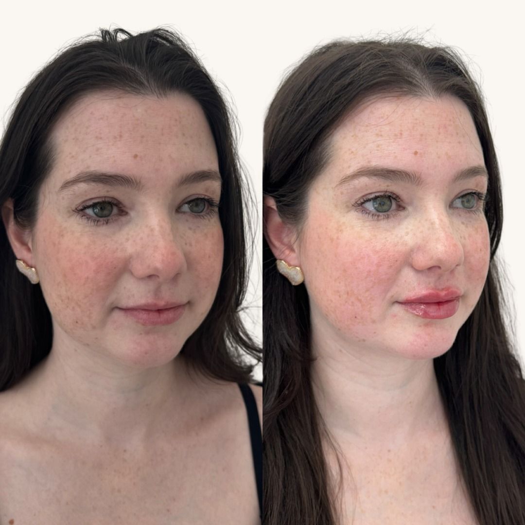 Dermal Fillers Before & After