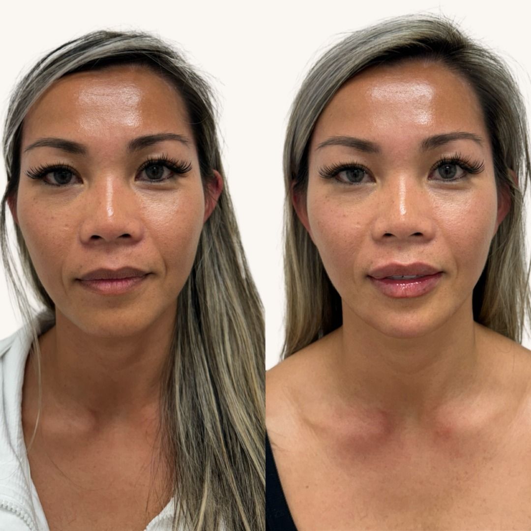 Dermal Fillers Before & After
