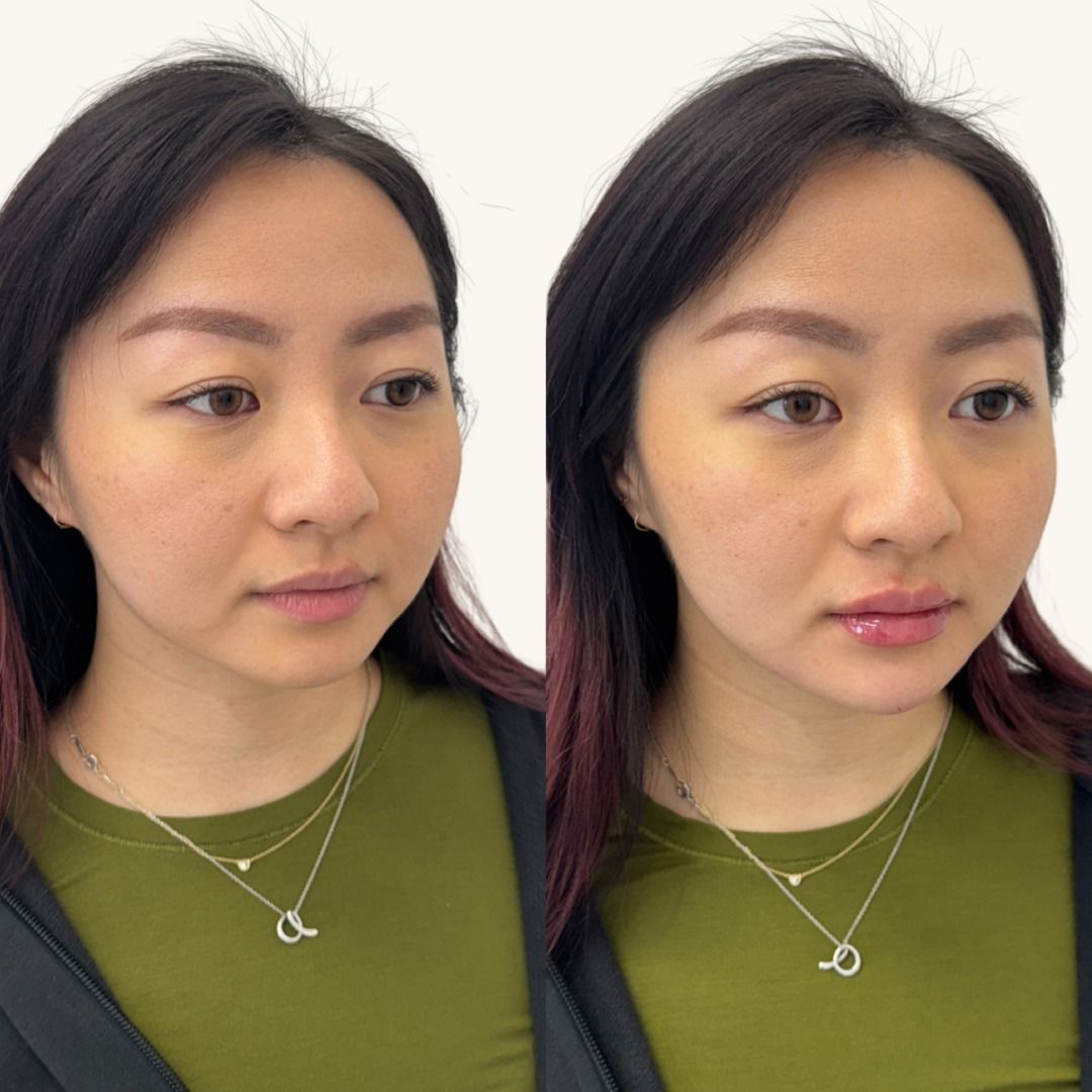 Dermal Fillers Before & After