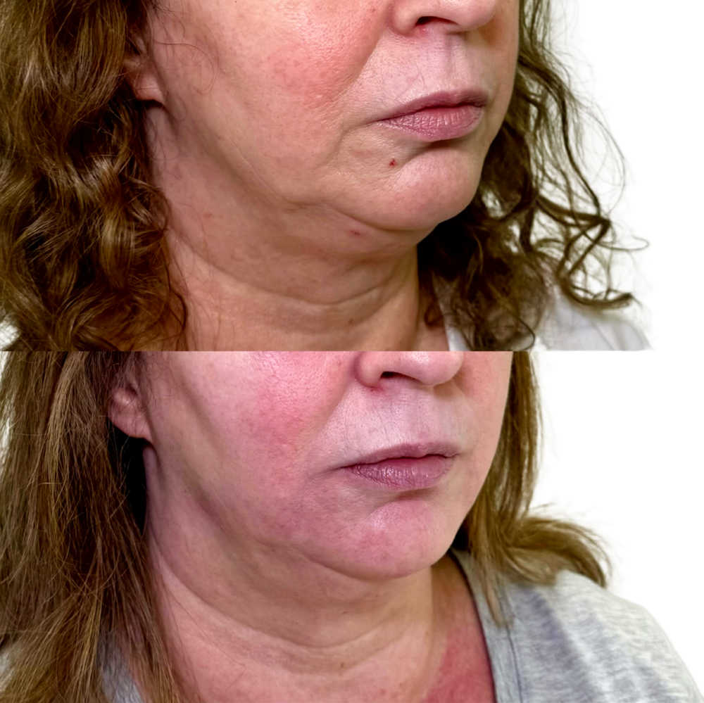 Juvederm Before & After