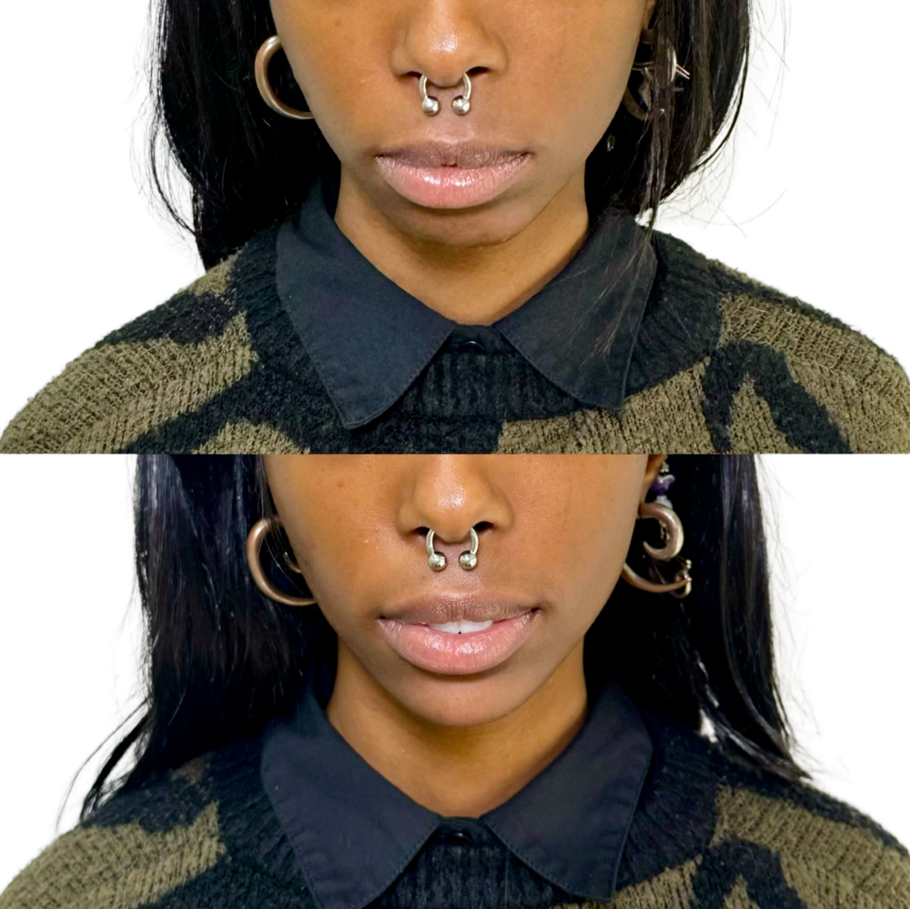 Juvederm Before & After