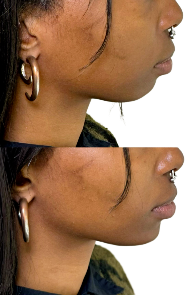 Juvederm Before & After