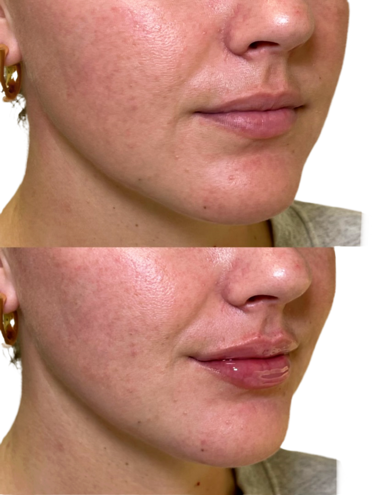 Juvederm Before & After