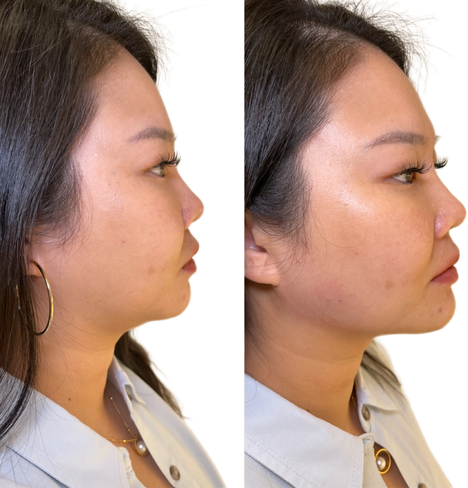 Juvederm Before & After