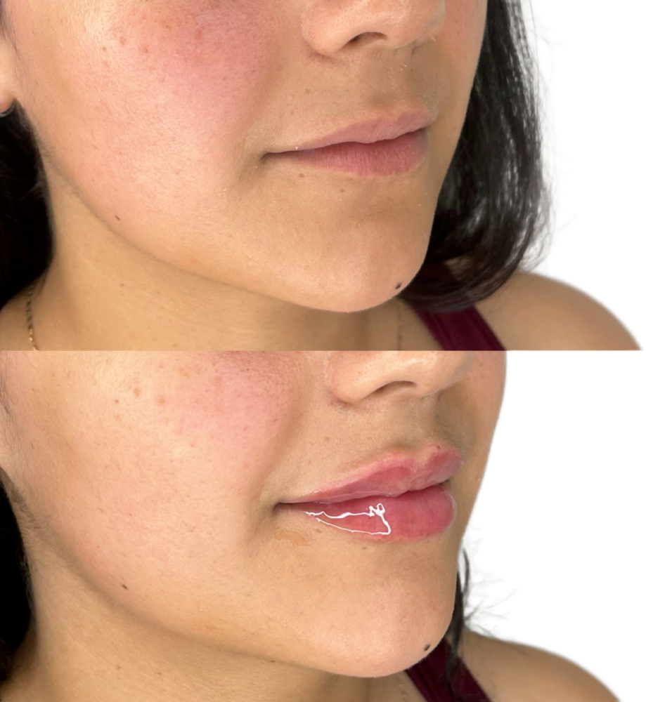 Juvederm Before & After