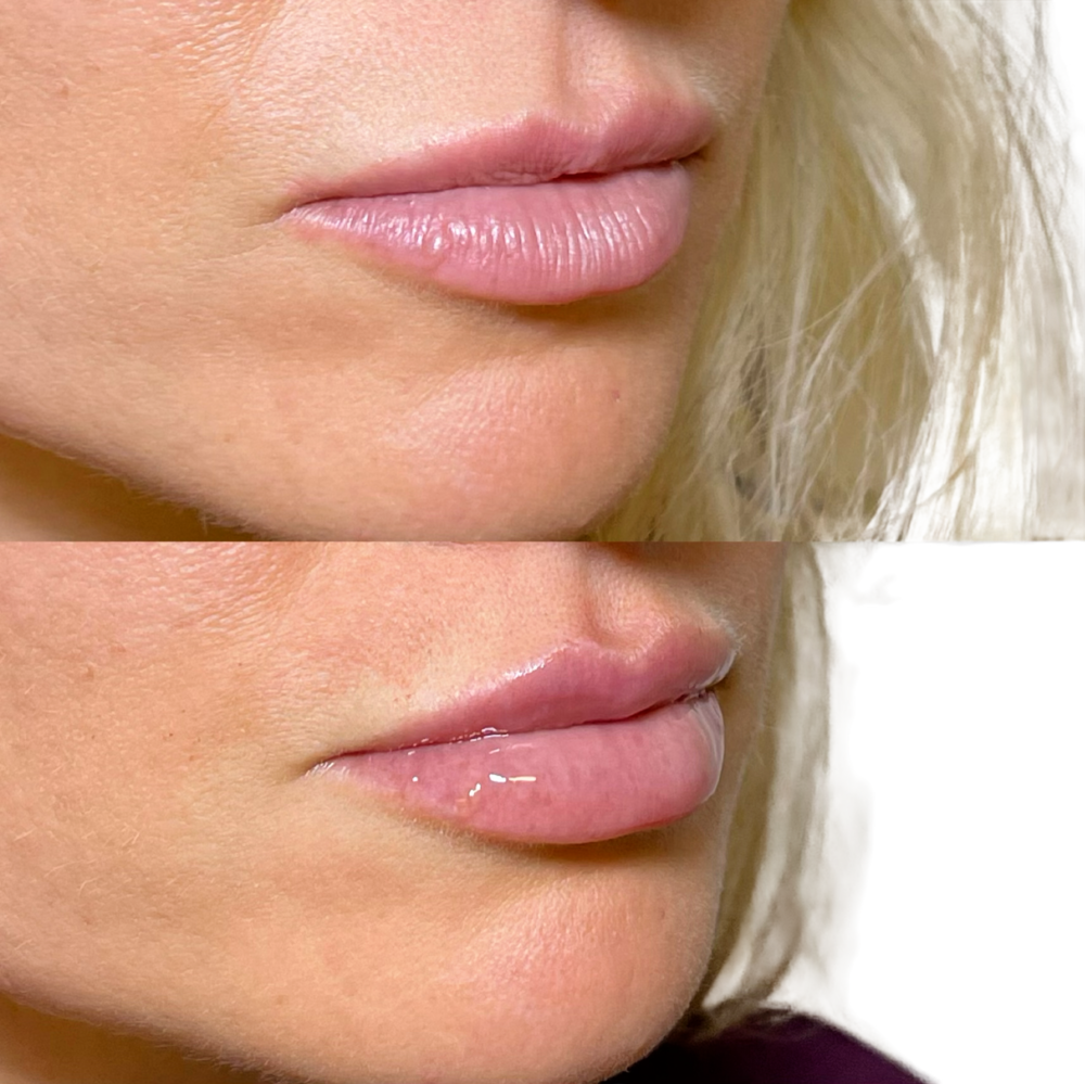 Juvederm Before & After