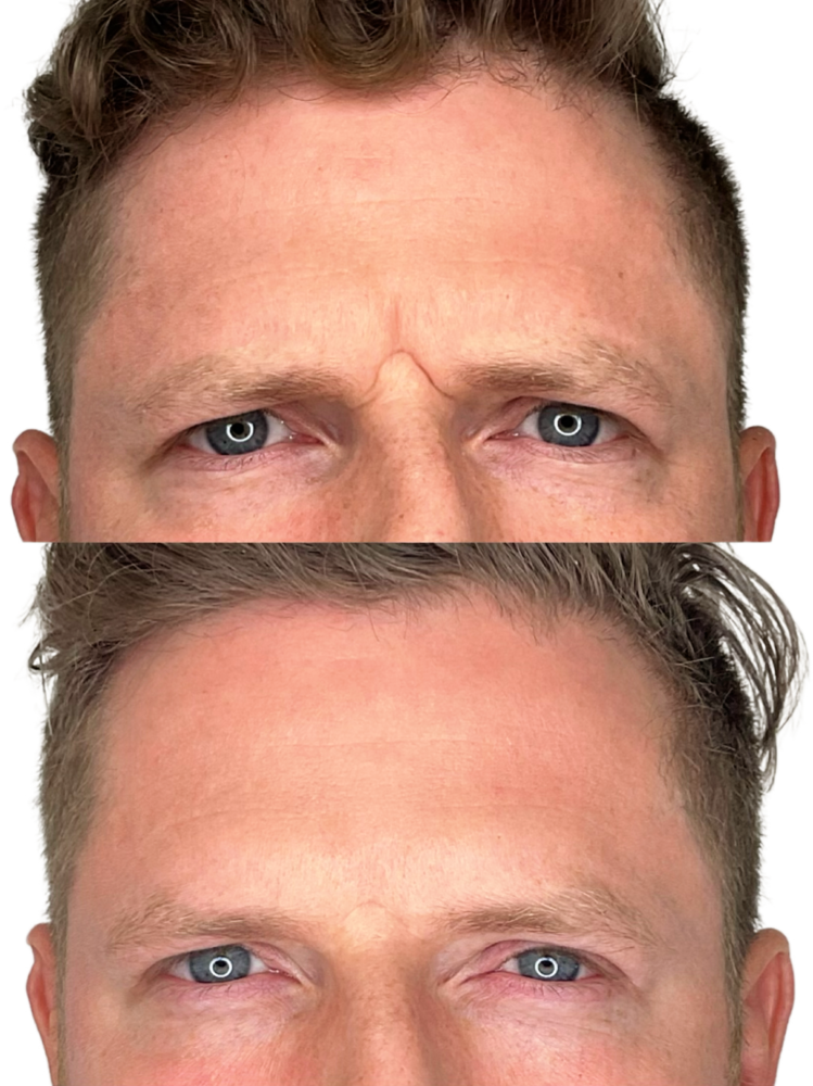 Botox Before & After