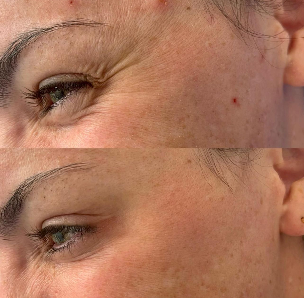 Botox Before & After