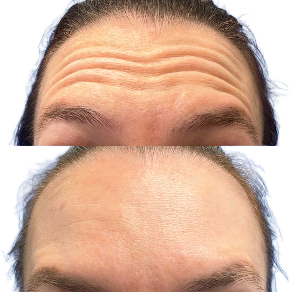 Botox Before & After