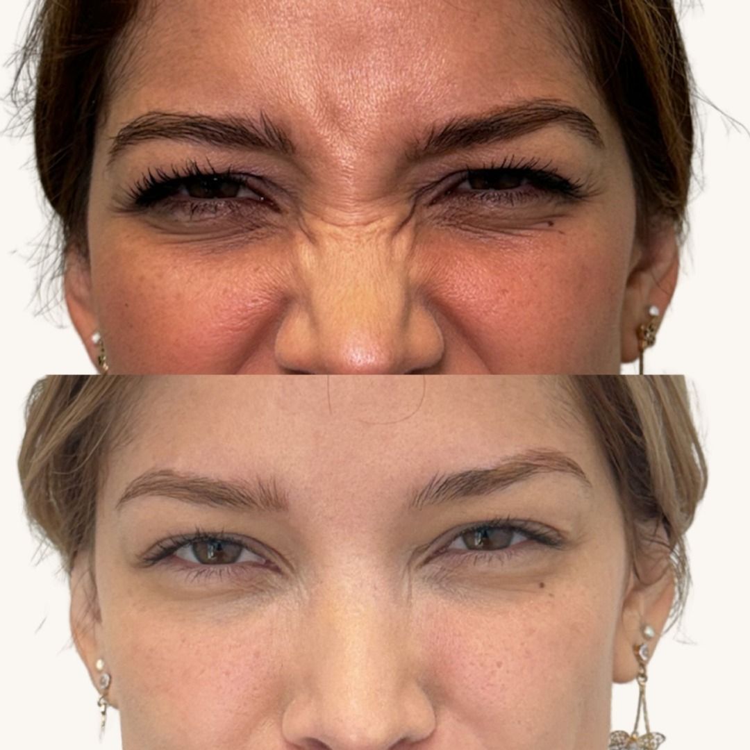 Botox Before & After