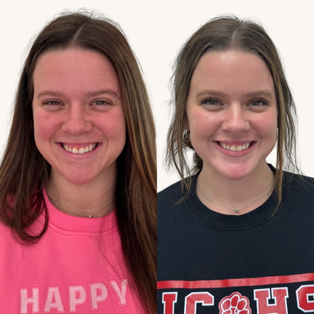 Botox Before & After