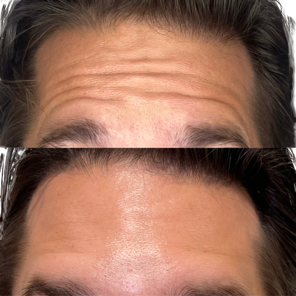 Dysport Before & After