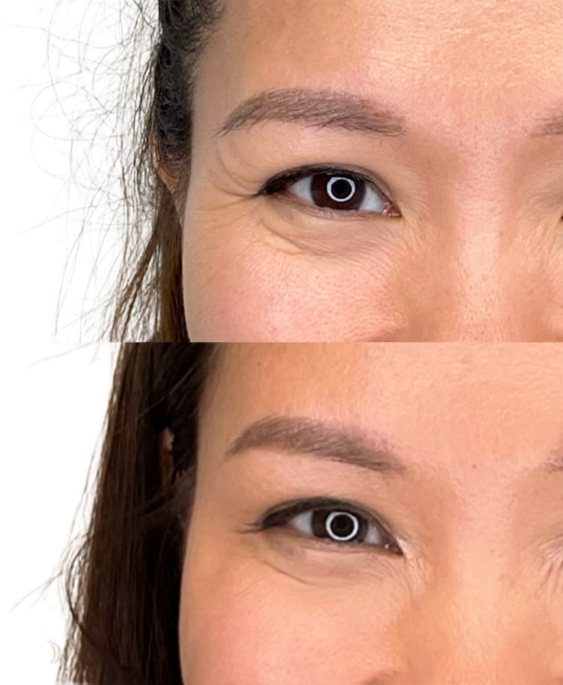 Dysport Before & After