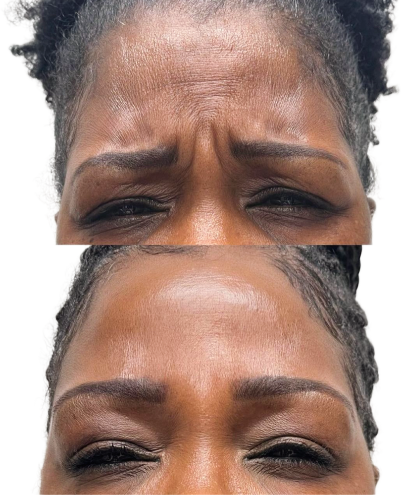 Dysport Before & After