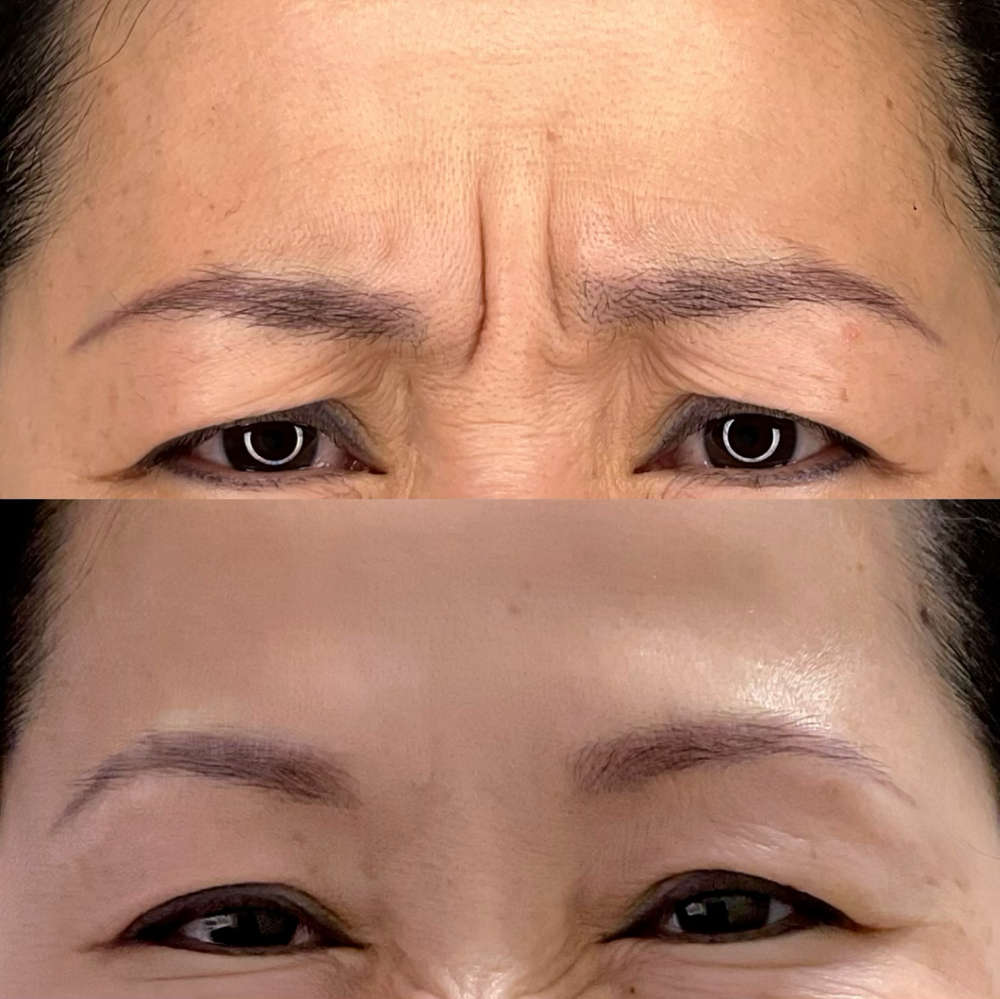 Dysport Before & After