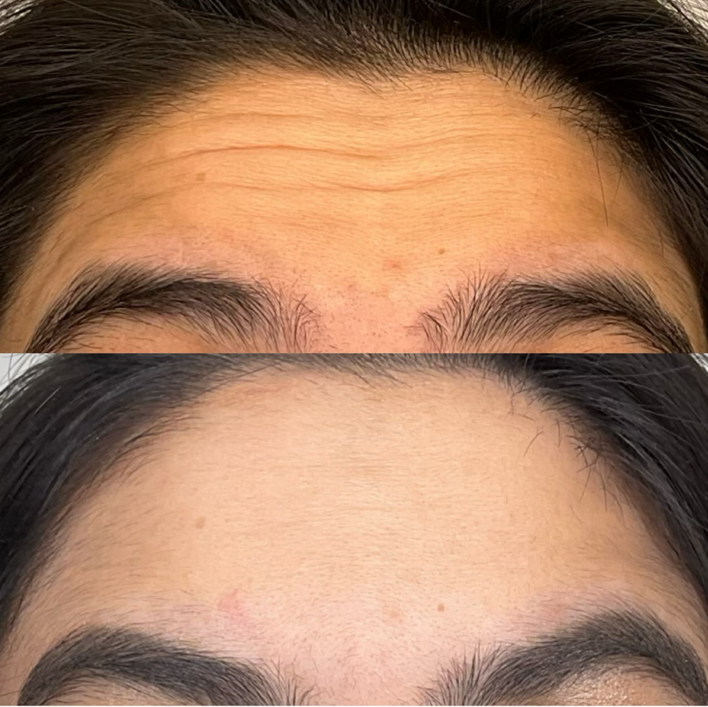 Dysport Before & After