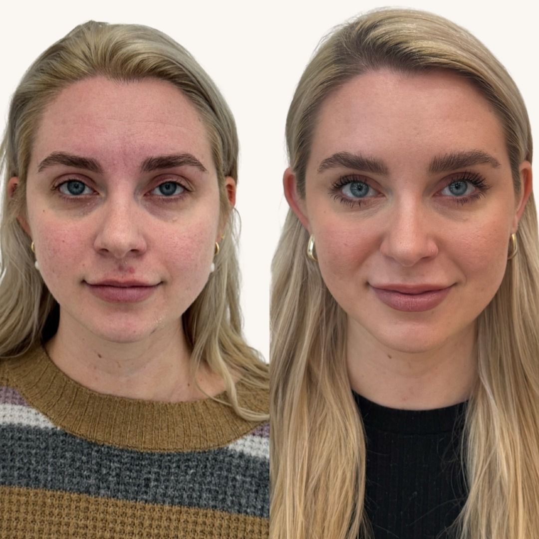 Dysport Before & After