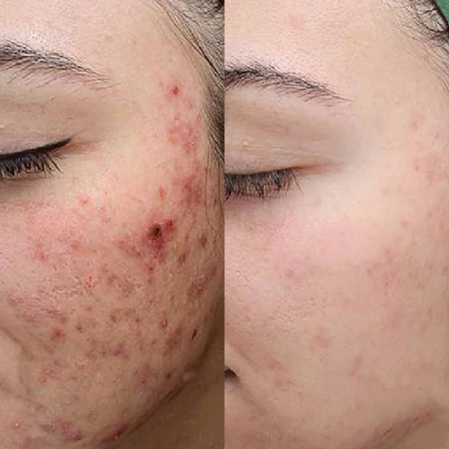 Chemical Peel Before & After