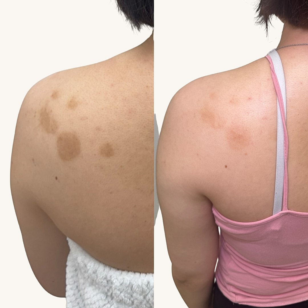 Chemical Peel Before & After