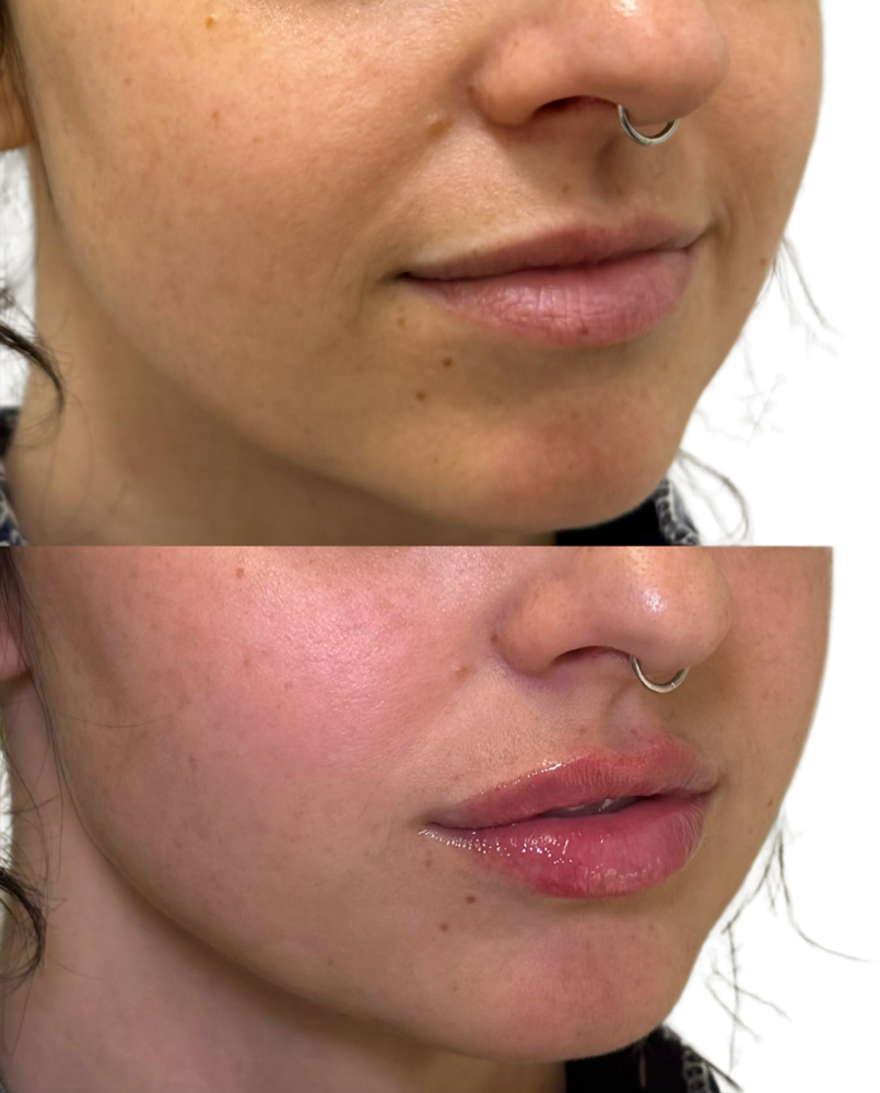 Restylane Before & After
