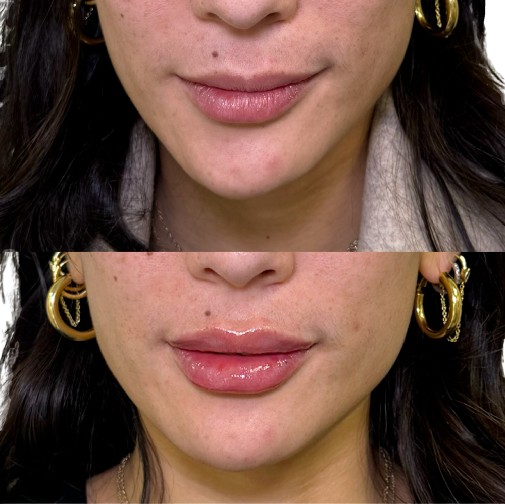Restylane Before & After