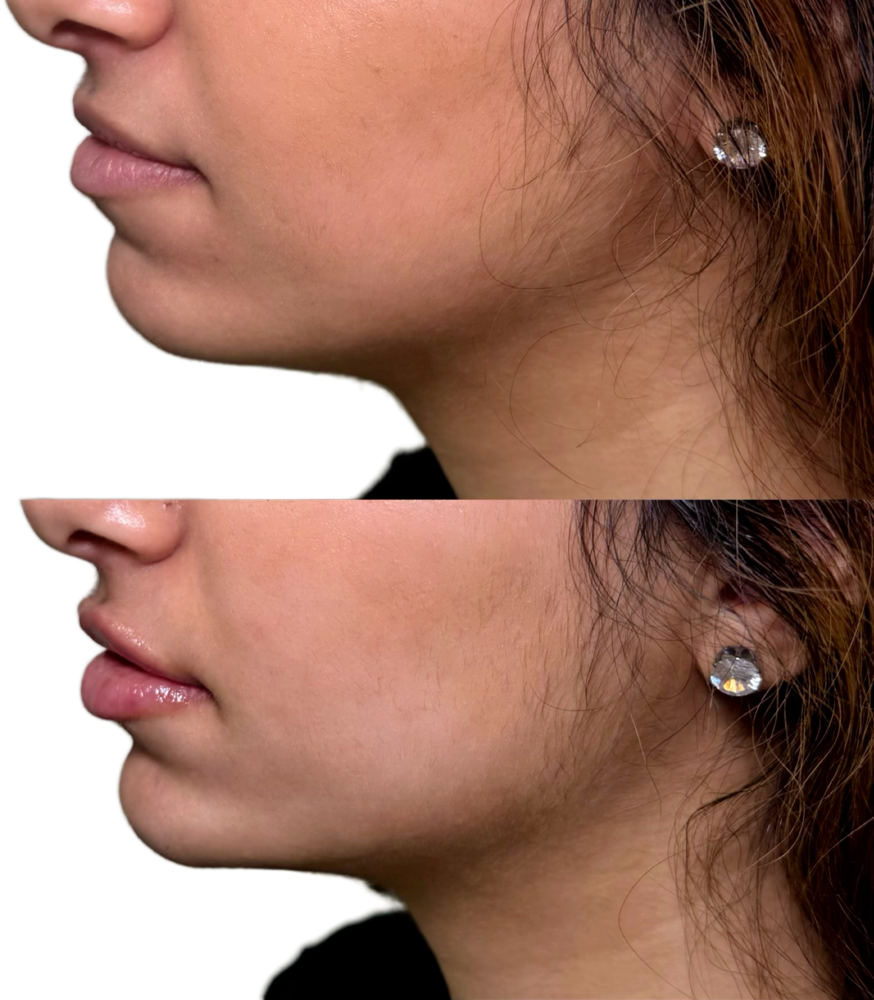 Restylane Before & After