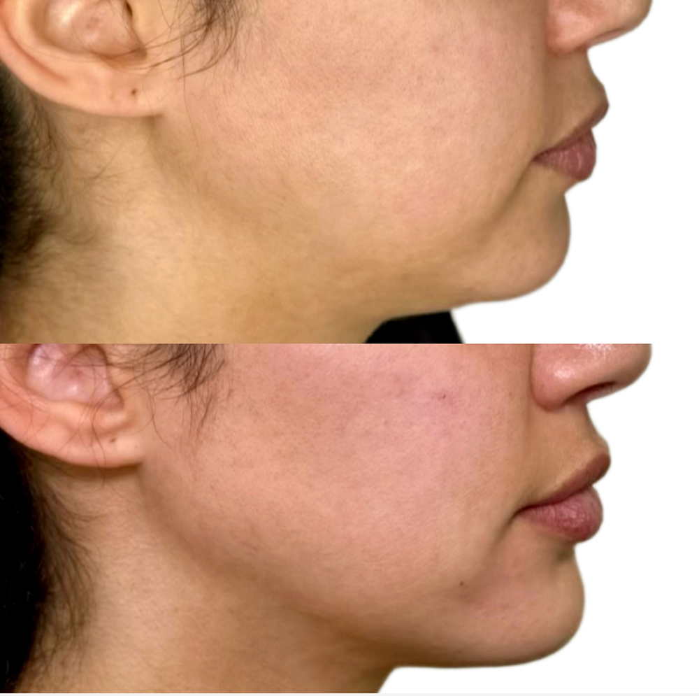 Restylane Before & After